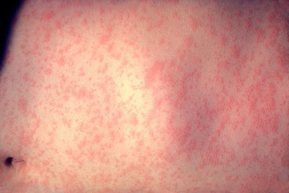 scabies rash