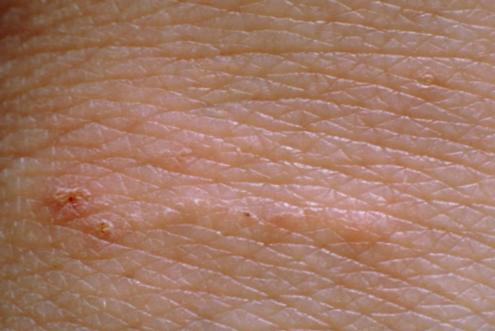 Scabies