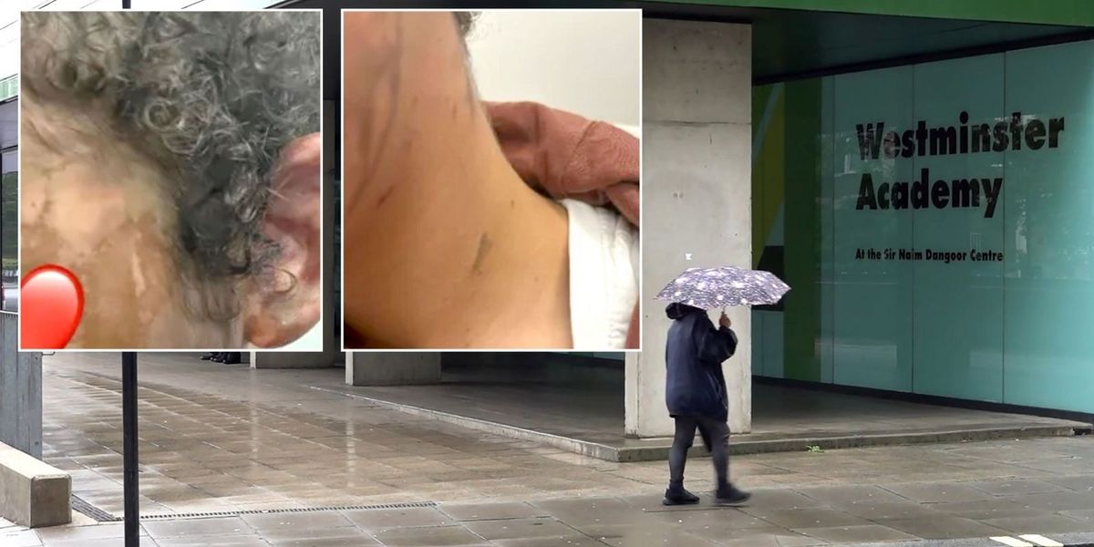 NextImg:Injuries of schoolgirl, 14, attacked with acid in broad daylight revealed in shocking pictures as dad sets up fundraiser