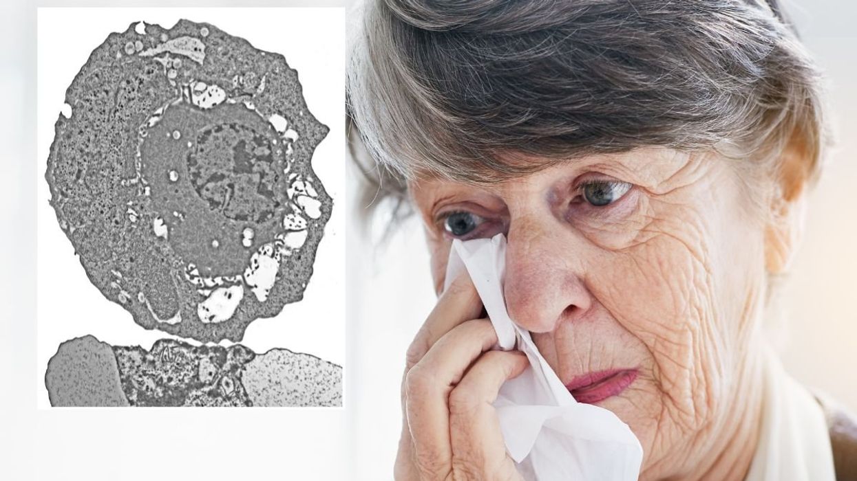SENIOR WOMAN EYE PAIN ADENOVIRUS MICROSCOPE