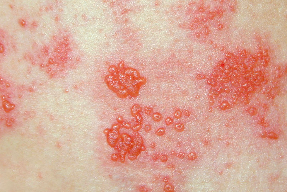 Shingles