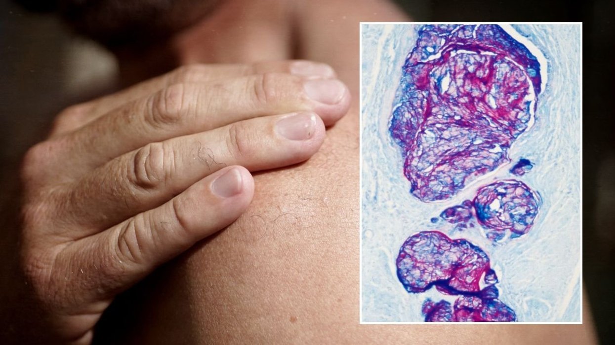 shoulder pain and cancer imaging