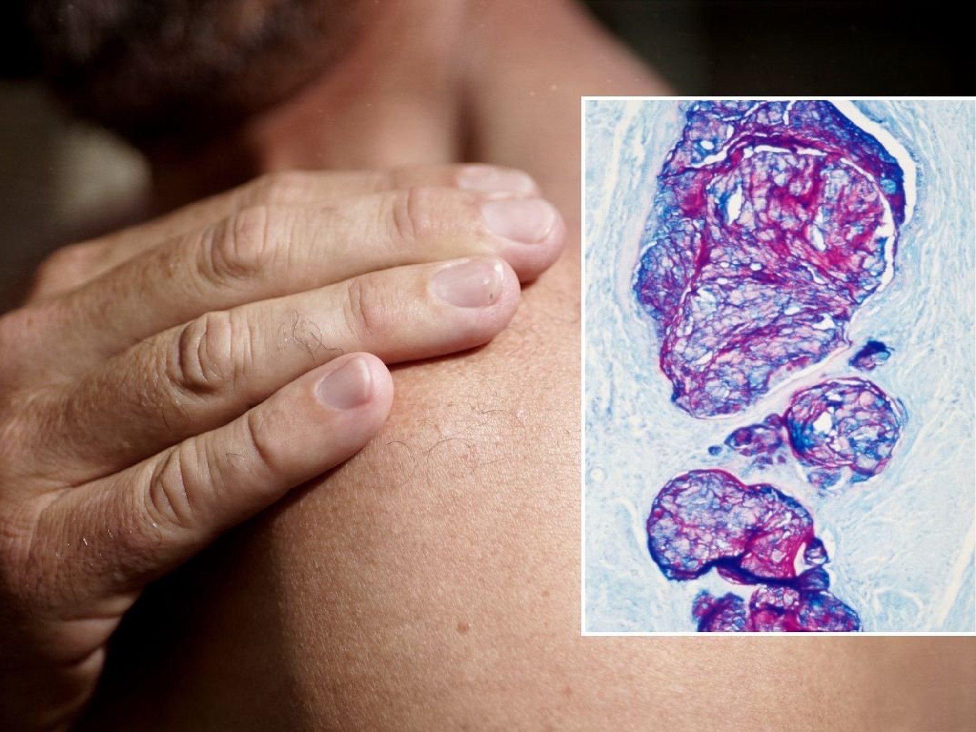 shoulder pain and cancer imaging