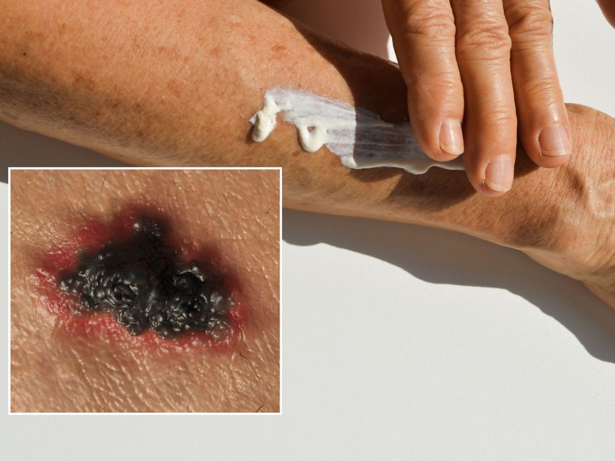 skin cancer and sun cream application