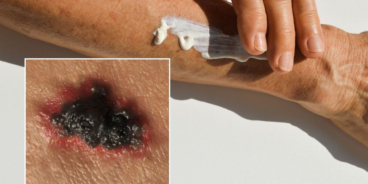 NextImg:Leading GP warns of sun cream application mistake putting Britons at risk of 'deadly cancers'