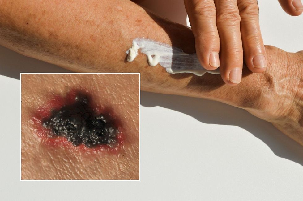 skin cancer and sun cream application