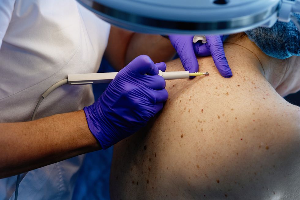 Checking skin cancer
