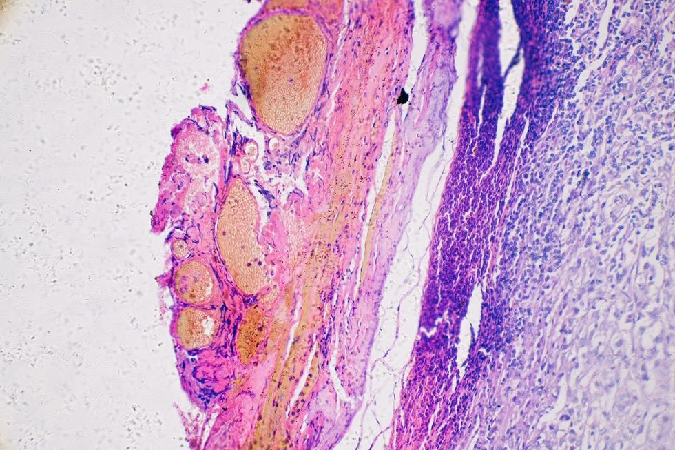 SKIN CANCER UNDER MISCROSCOPE