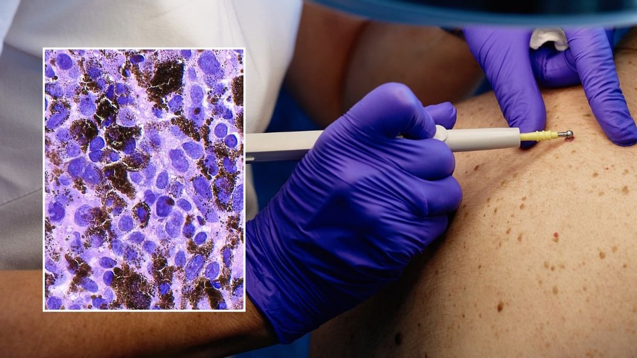 SKIN INSPECTION MELANOMA