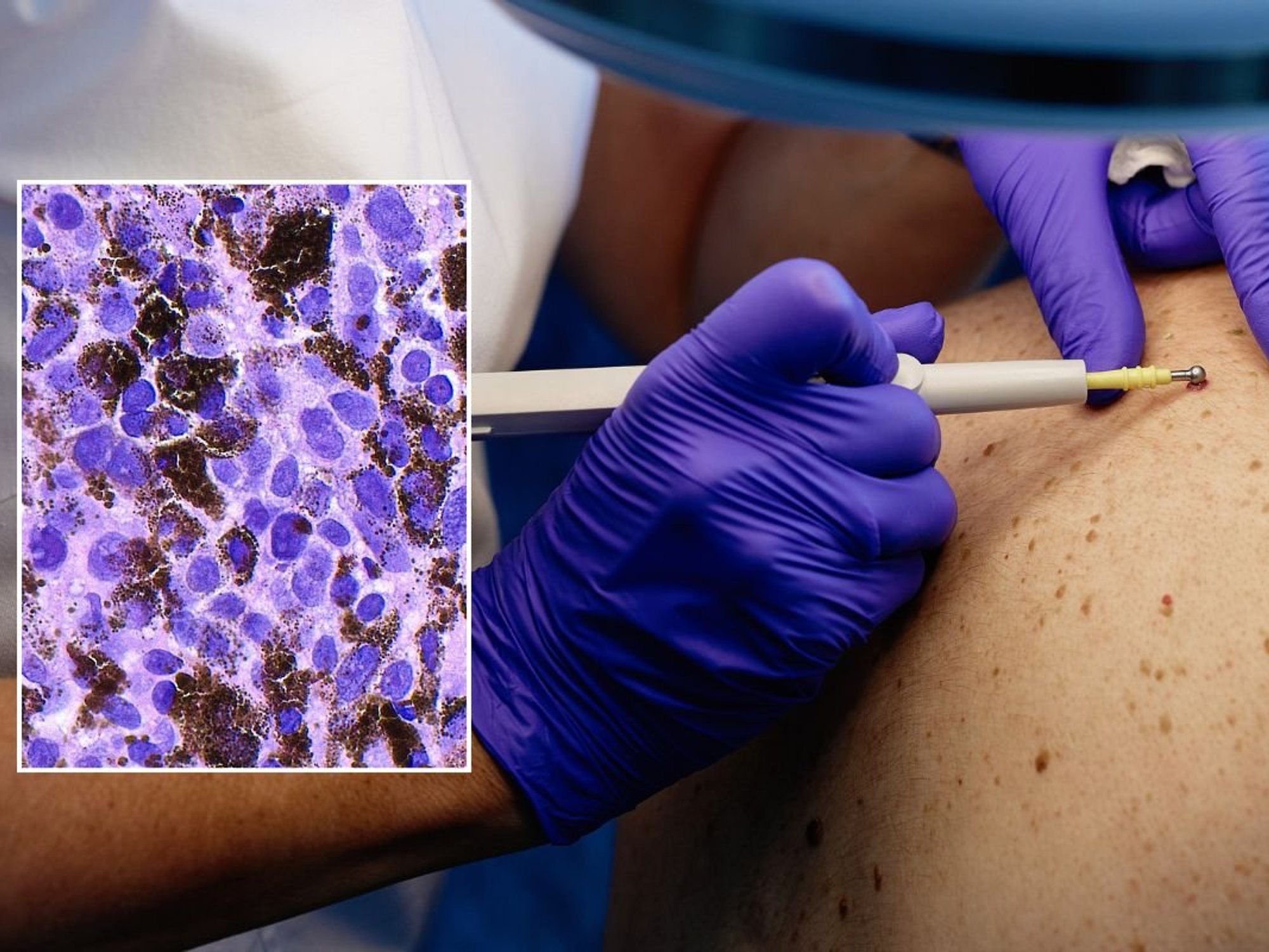 SKIN INSPECTION MELANOMA