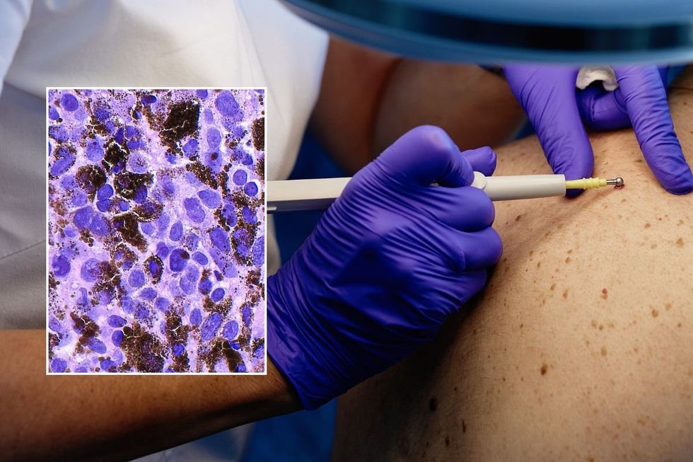 SKIN INSPECTION MELANOMA
