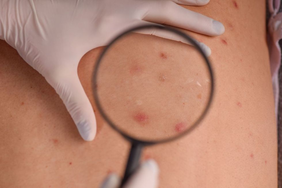 SKIN TAG STOCK IMAGE