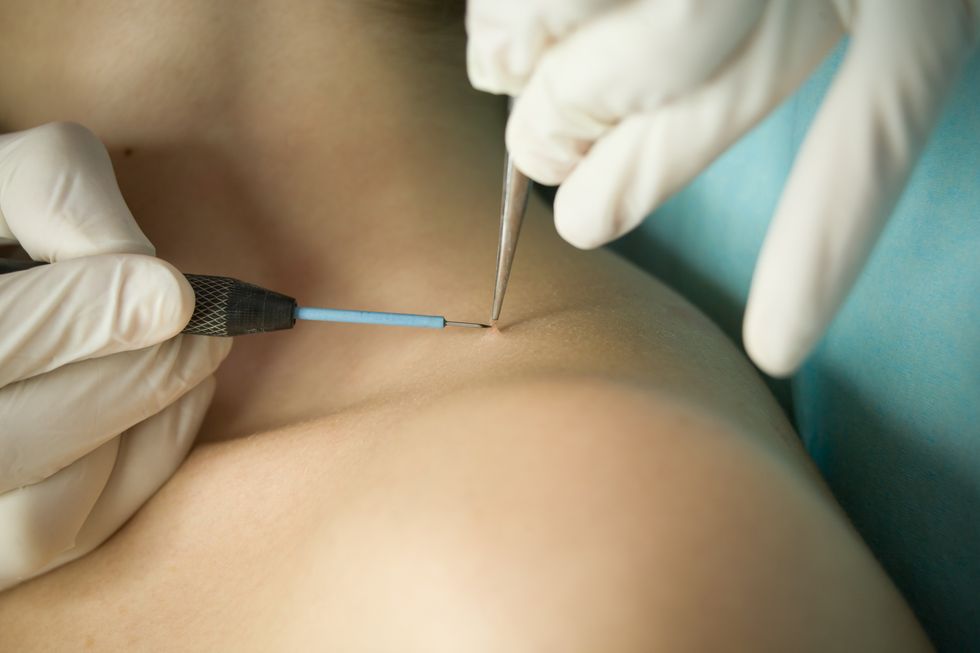 SKIN TAGS ON SHOULDER
