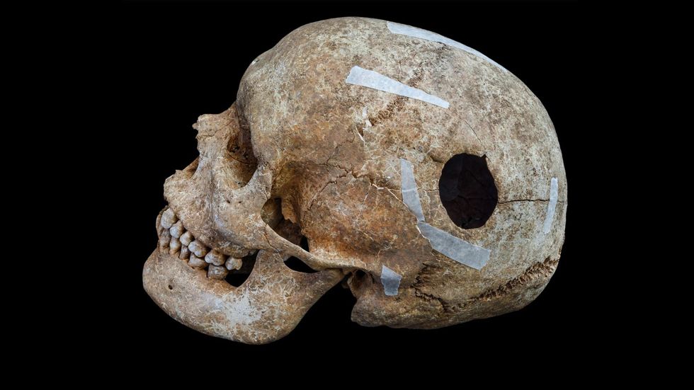Skull with evidence of trepanning