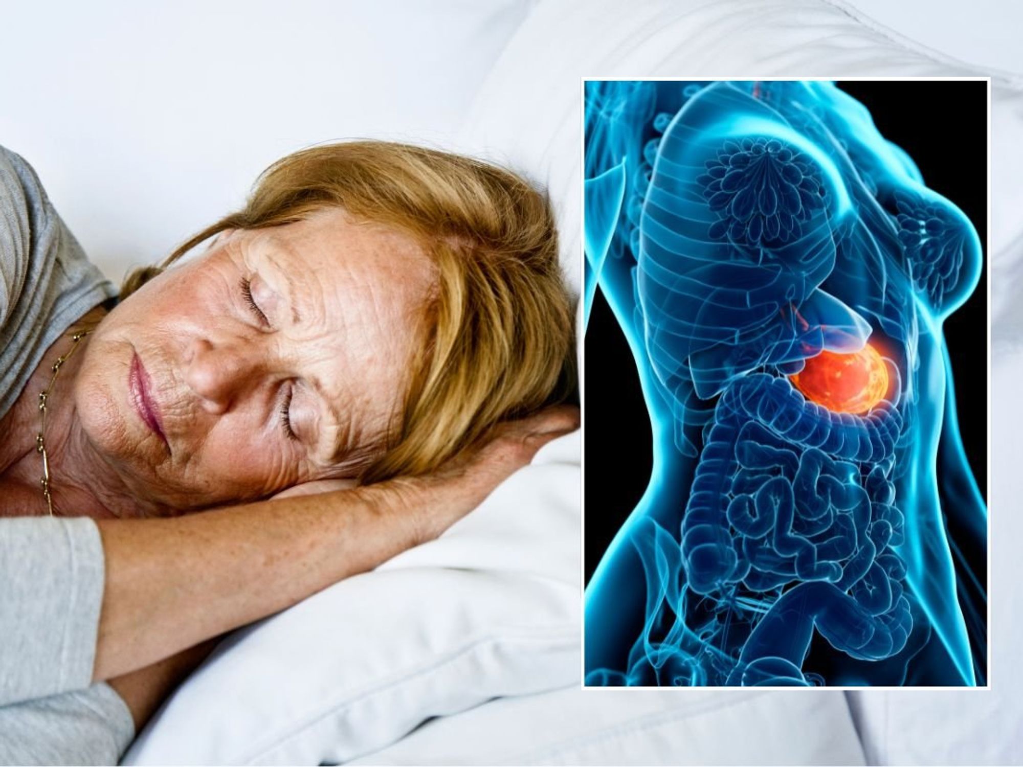 SLEEPING WOMAN AND STOMACH FLARE-UP ILLUSTRATION