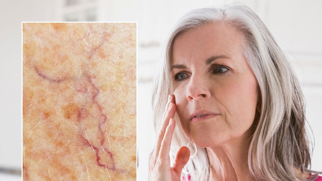 Spider vein / Woman touching face in mirror