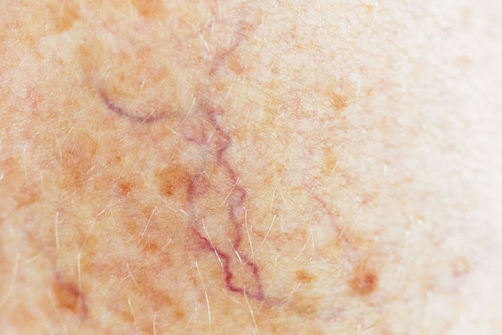 Spider veins