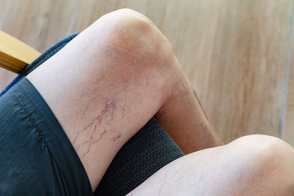 Spider veins