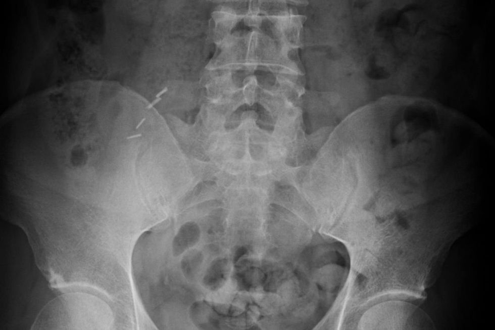 SPINAL X-RAY