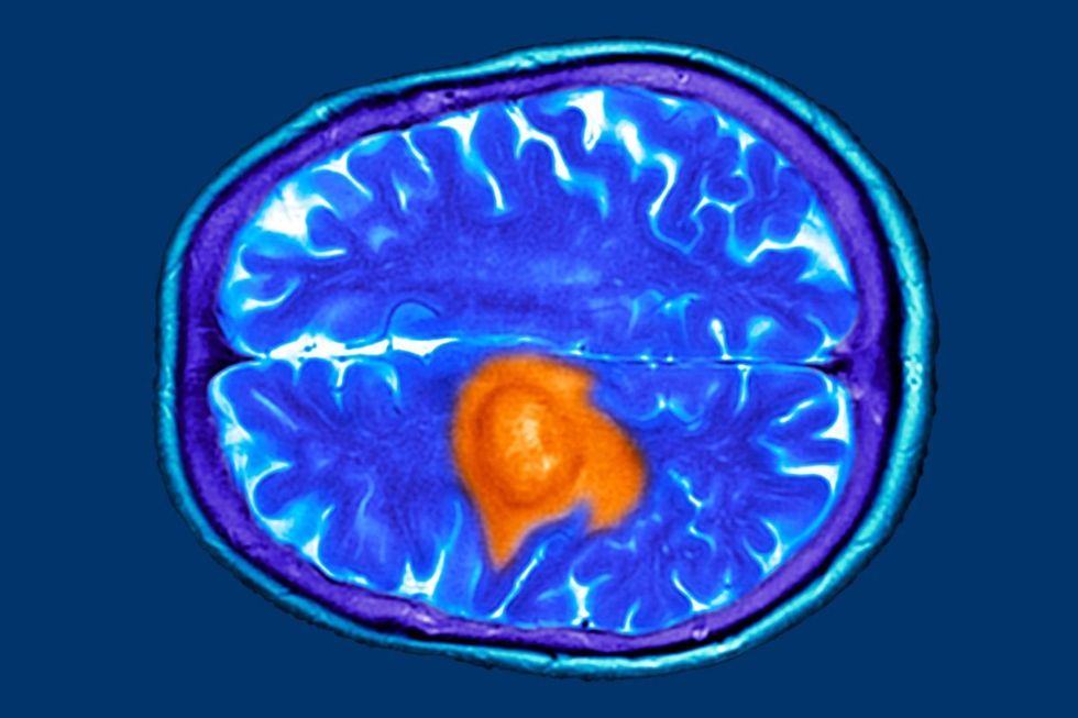 STROKE BRAIN IMAGING