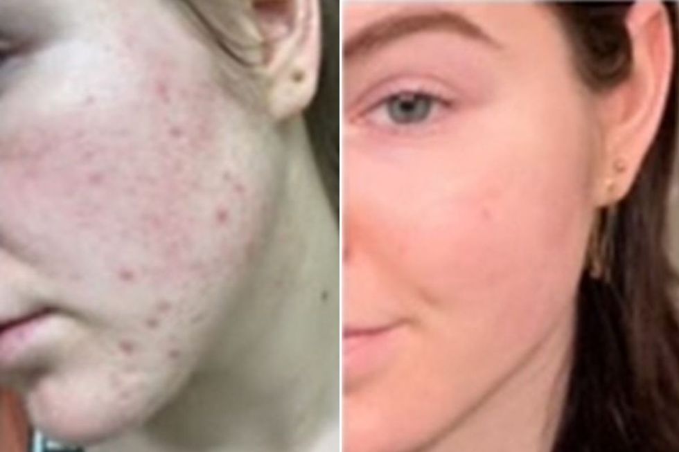 Sylvia skin before and after