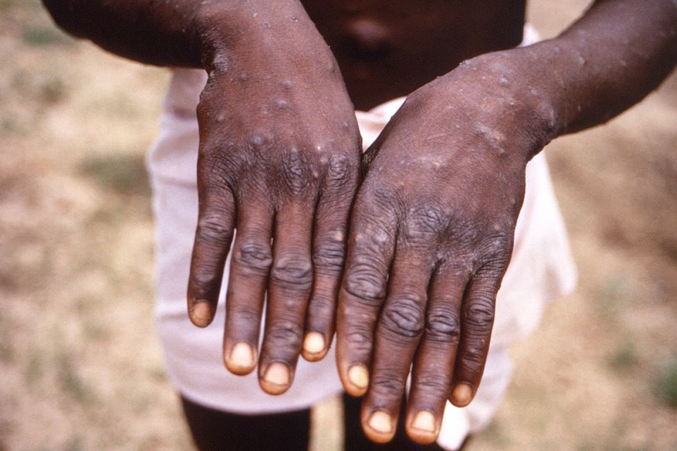 The hands of a patient with a rash due to monkeypox.