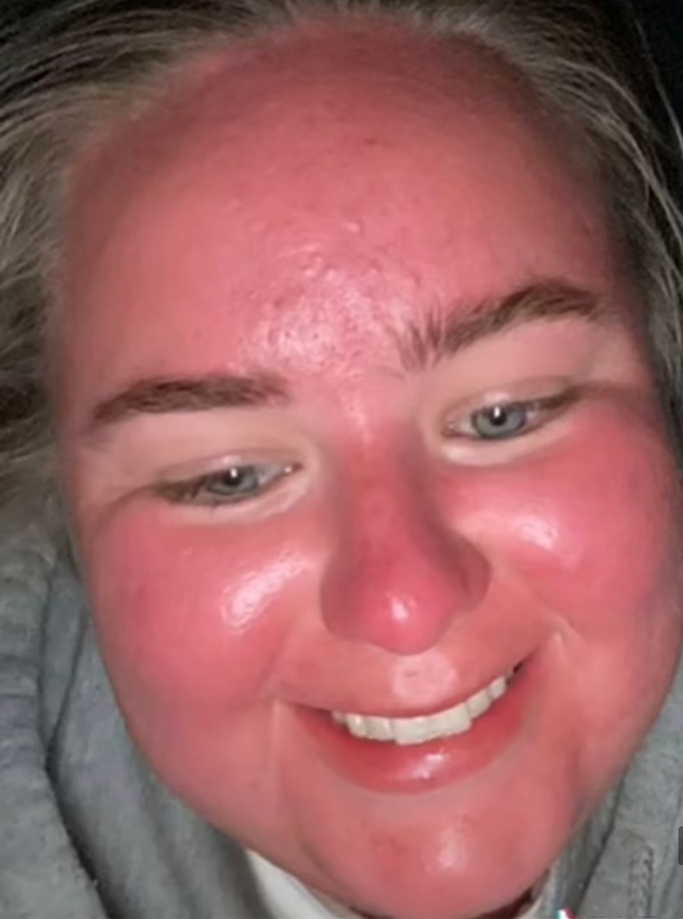 The TikTok user shows the transformative impact the sun had on her face.