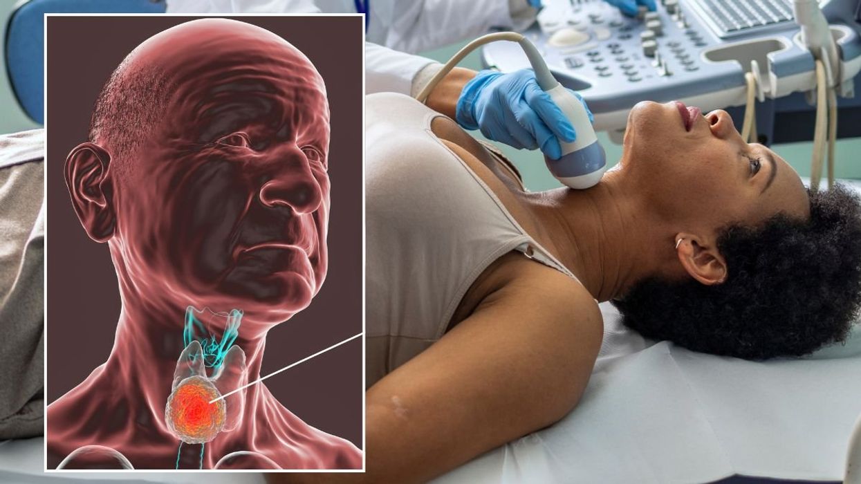 Throat cancer illustration