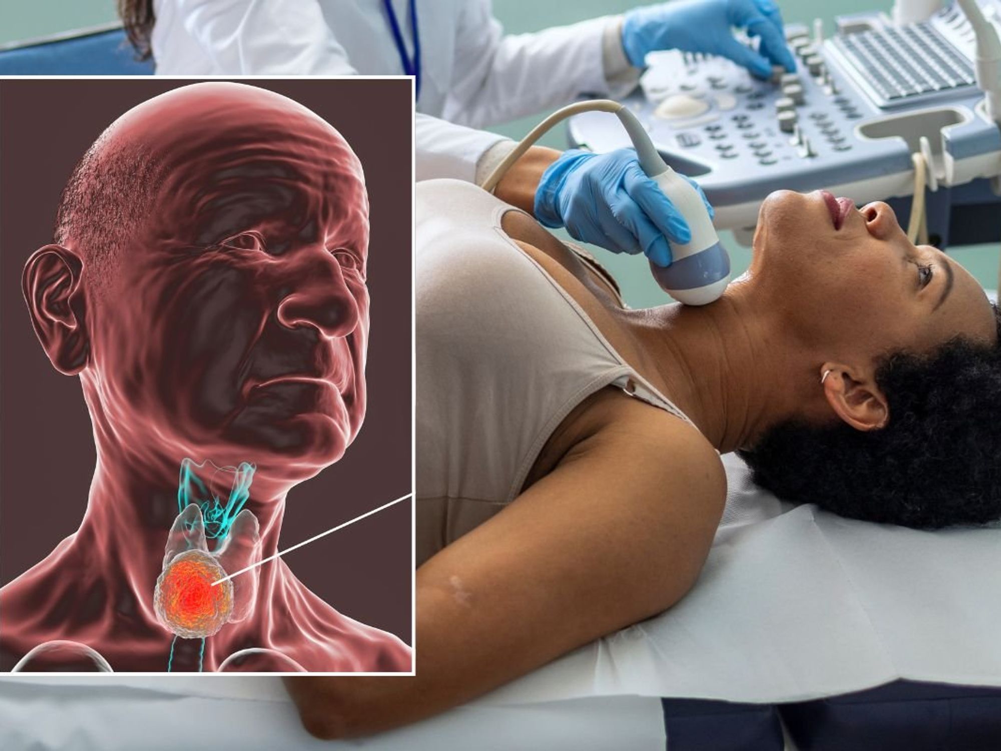 Throat cancer illustration