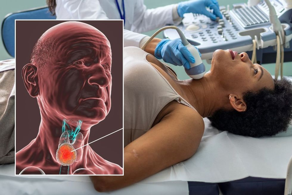 Throat cancer illustration