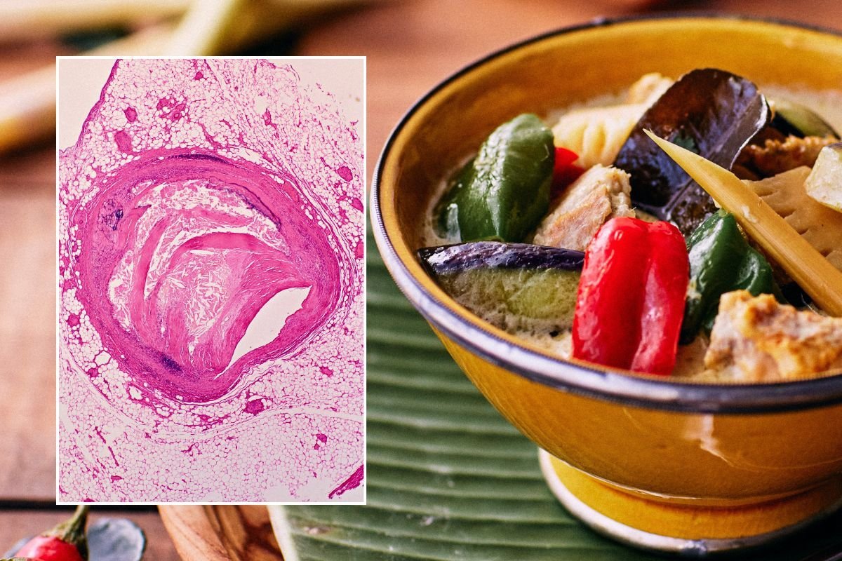 TOFU BOWL AND ATHEROSCLERORIS UNDER MICROSCOPE