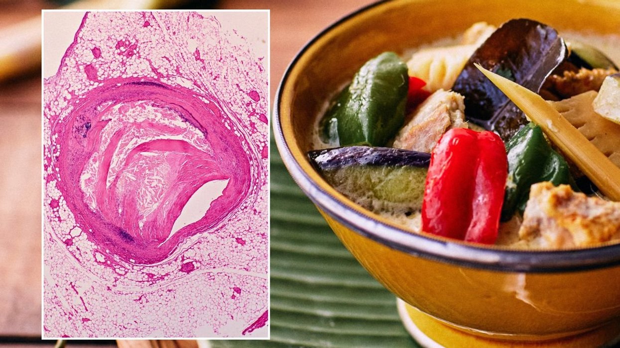 TOFU BOWL AND ATHEROSCLERORIS UNDER MICROSCOPE