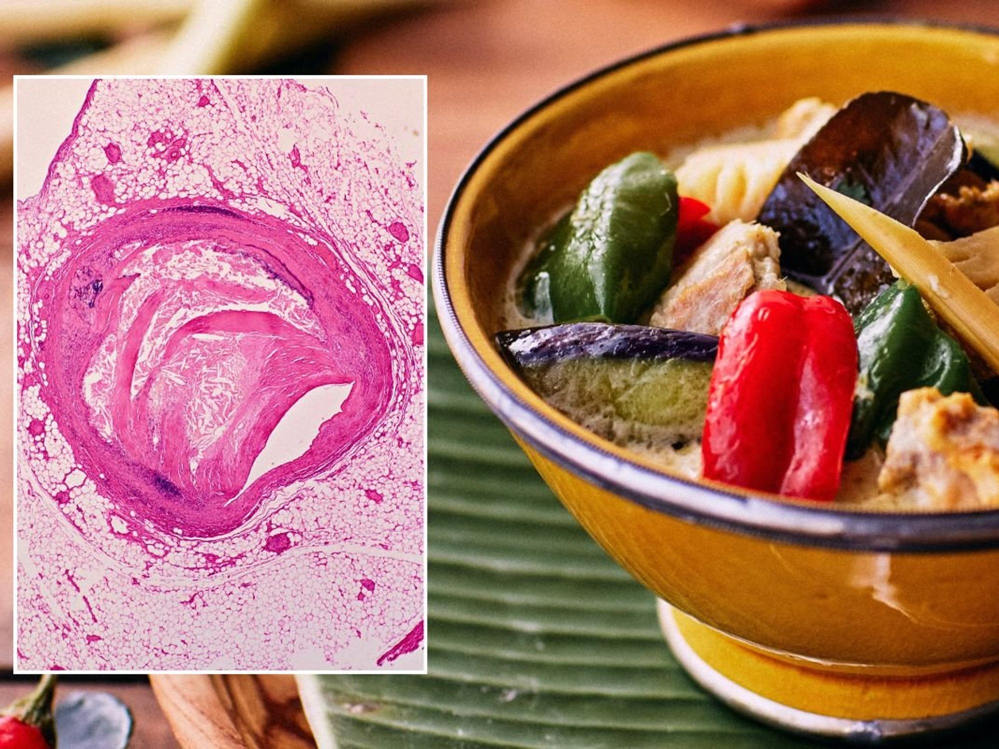 TOFU BOWL AND ATHEROSCLERORIS UNDER MICROSCOPE