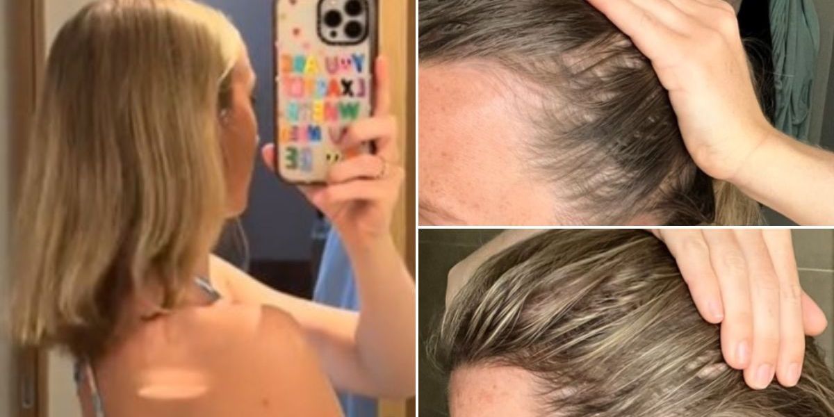 NextImg:Hair care: 'I battled against bald patches for years - until a proven treatment gave me results in weeks'