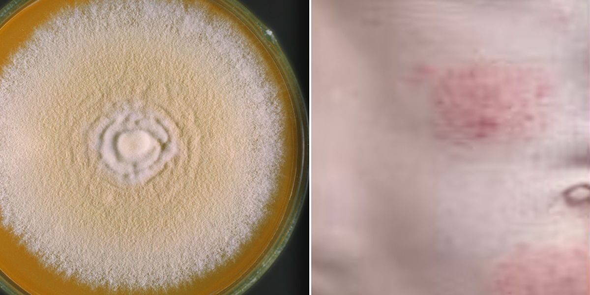 NextImg:Doctors issue warning over hard-to-treat 'super-fungus' likely to be spreading undetected in Britain