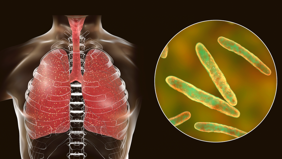 Tuberculosis-infected lung