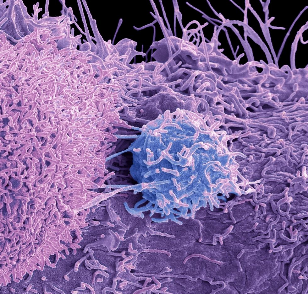 TUMOUR ILLUSTRATION