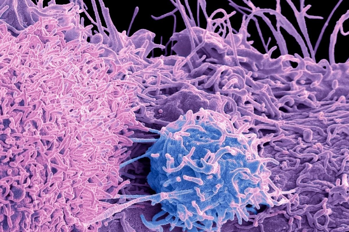 TUMOUR ILLUSTRATION
