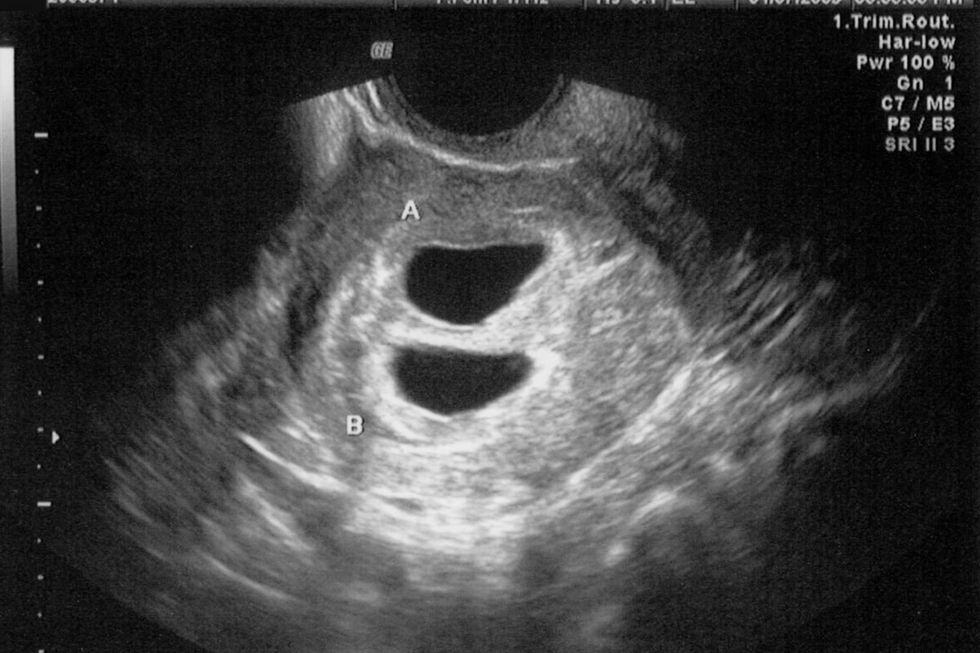 TWINS IN WOMB