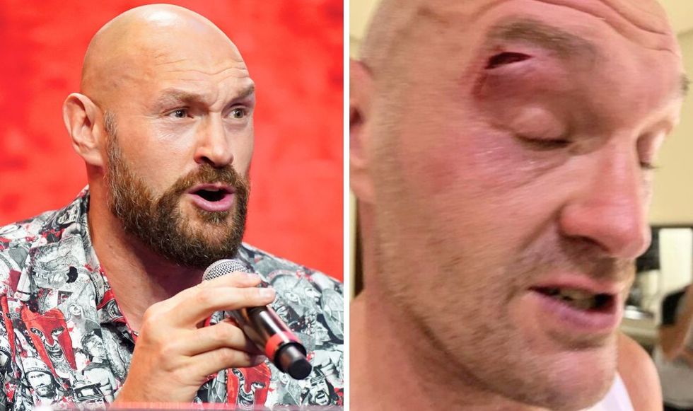 Tyson Fury cut