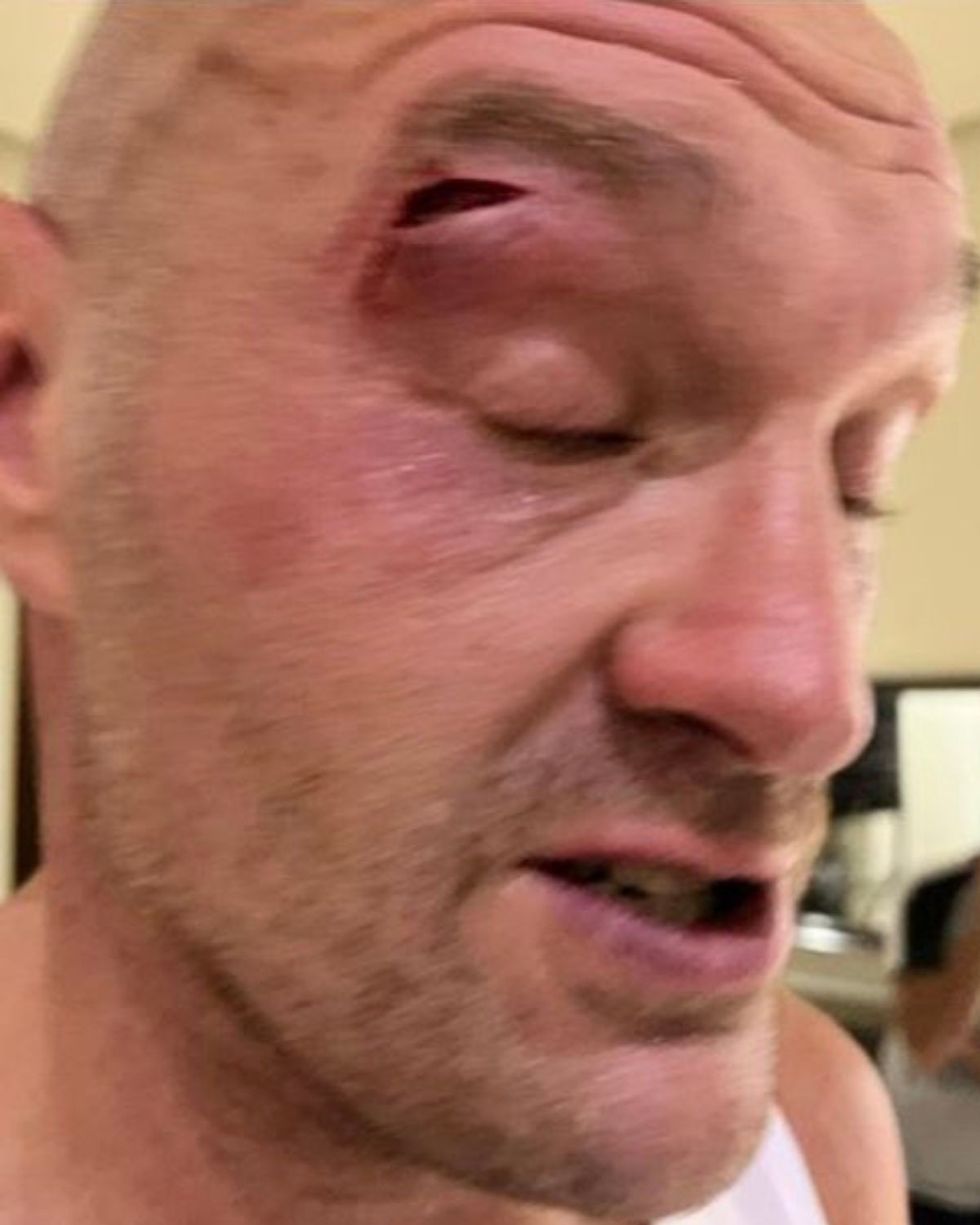 Tyson Fury cut