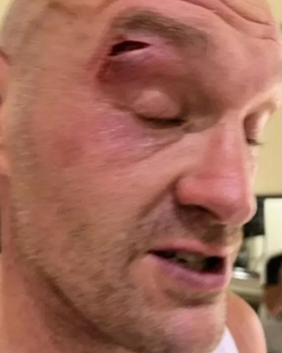 Tyson Fury eye cut