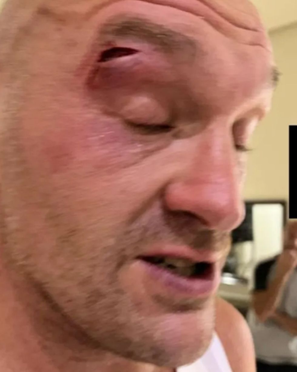 Tyson Fury eye injury