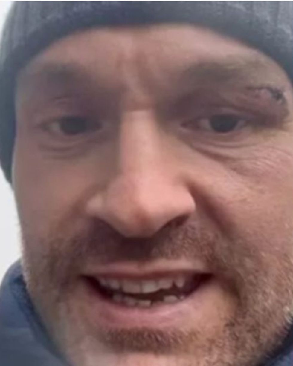 Tyson Fury eye injury