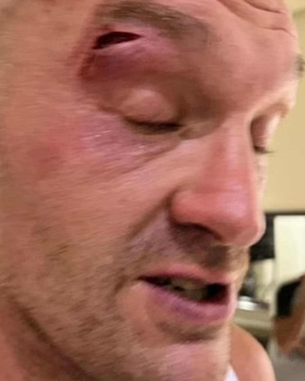 Tyson Fury eye injury