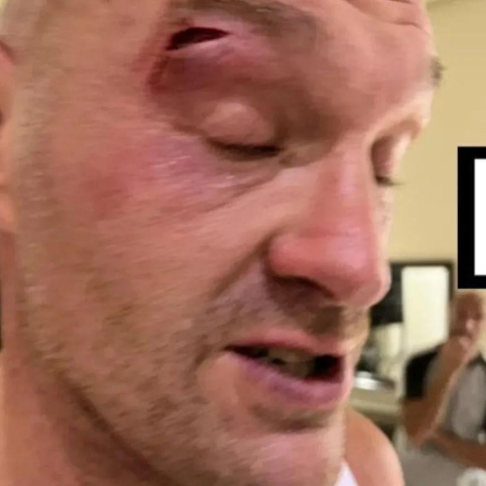 Tyson Fury eye injury