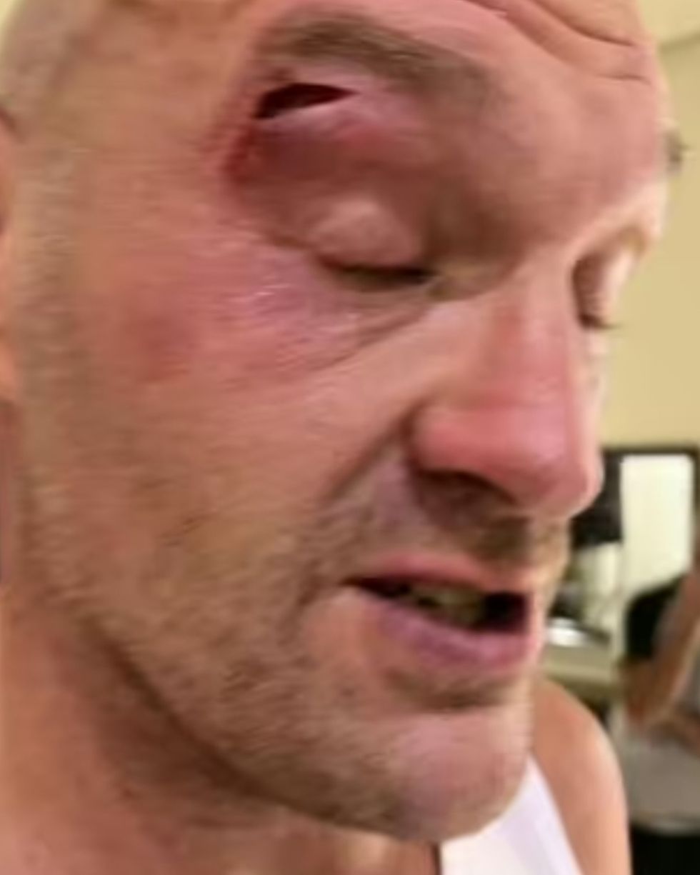 Tyson Fury eye