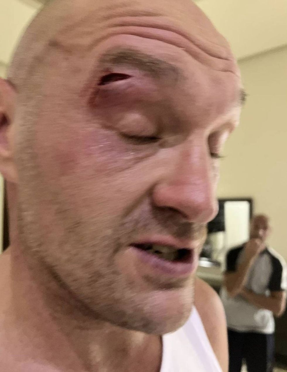 Tyson Fury will need several months to recover