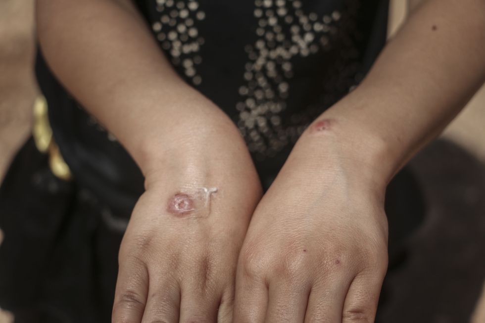 \u200bA Syrian kid suffering from leishmaniasis, a parasitic disease spread by the bite of sandflies