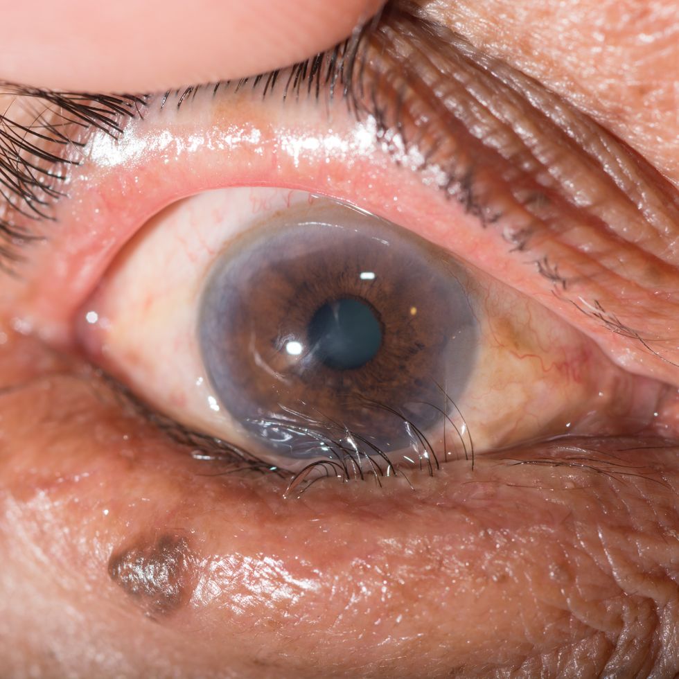 \u200bCorneal arcus